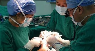В Китае врачи прооперировали юношу с 9 пальцами на одной ноге (8 фото + 1 видео)