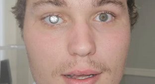 Власник ювелірної крамниці вставив у око діамант у 2 карати (5 фото + 1 відео)