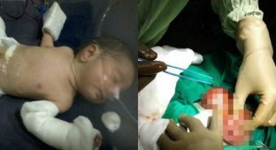 В Индии родился ребенок, «беременный» братом-близнецом (6 фото)