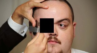 Человек с самыми выпирающими глазами в мире (4 фото) (жесть)
