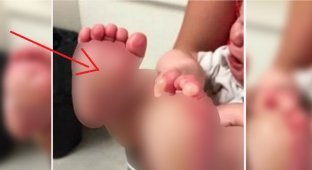 Мать вернулась домой и увидела огромные волдыри на ногах у ребенка (3 фото)