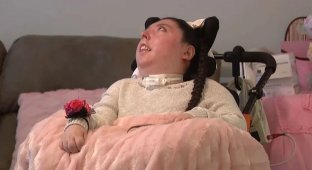 Girl Born Without a Brain Turns 20 (4 photos)