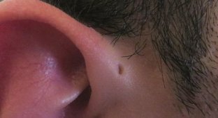 Вот почему некоторые люди рождаются с крошечным отверстием возле ушей (7 фото)