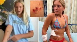 The schoolgirl was attacked twice by a shark, but the girl managed to fight back (3 photos + 1 video)