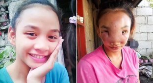 Молодая филиппинка, выдавив прыщ, осталась без лица (6 фото + 1 видео)