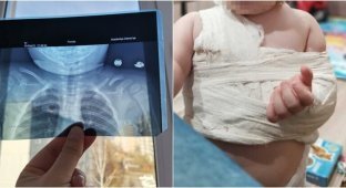 Врачи лечили у ребенка перелом мазью от ушибов (3 фото)