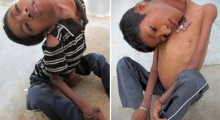 Полсотни индийских врачей не смогли понять, чем болен 12-летний мальчик с «резиновой» шеей (5 фото)