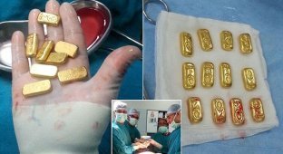 Извлечение золотых слитков из желудка (5 фото)