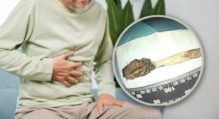 Врачи извлекли зубную щётку, которую мужчина проглотил более 50 лет назад (4 фото + 1 видео)