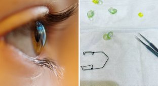 Врач достала 23 контактные линзы из глаза забывчивой пациентки (4 фото + 1 видео)