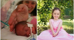 What does a premature baby girl look like now, weighing 669 grams at birth (12 photos)