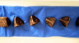 У сечовому міхурі чоловіки виявили шість величезних каменів: вага та розмір шокують (4 фото)