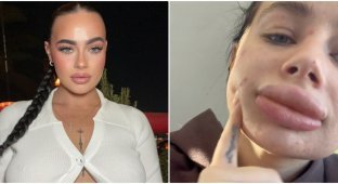 The girl enlarged her lips and regretted it - she shared her bad experience in social networks (5 photos)