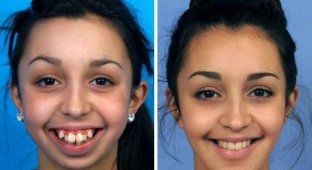 Невероятное преображение девушки после пластической коррекции челюсти (2 фото)