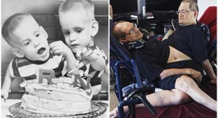 Самые пожилые сиамские близнецы скончались в возрасте 68 лет (10 фото)