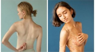 Фотопроект: люди показывают свои шрамы и рассказывают о том, как их получили (16 фото)