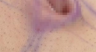 Guy from Argentina sewed up his belly button because he was tired of cleaning it (2 photos + 2 videos)