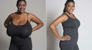 Хирурги четыре часа избавляли женщину от 14-килограммовой груди (6 фото)