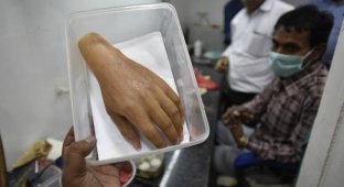 3D-печать протезов приходит в Индию (6 фото)