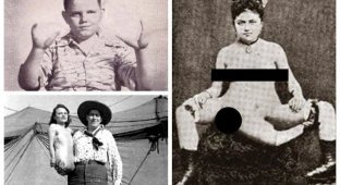 Реальные люди из прошлого с пугающими мутациями (15 фото)