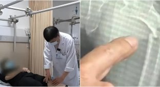 35-річний китаєць зламав стегнову кістку в результаті кашлю (3 фото)