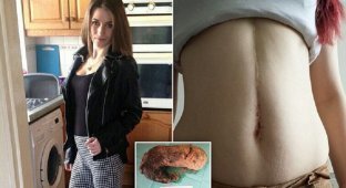 Хирурги удалили из желудка девушки 1,5-килограммовый ком волос (7 фото)