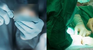 Хірурги із Сочі забули в тілі пацієнтки скальпель, який виявили за кілька місяців (2 фото)