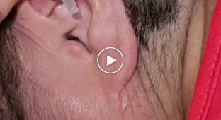 Why you need ear drops in Australia
