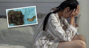 14-летняя девочка из Китая выдрала и съела 3 кг волос (3 фото)