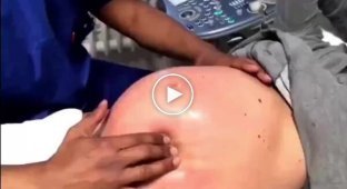 Німецький акушер перевертає дітей у животі матері, щоб уникнути кесаревого розтину
