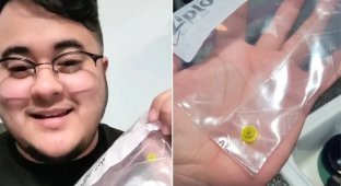 A guy lived with a Lego piece in his nose for over 25 years (3 photos + 1 video)