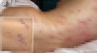 Іспанець потрапив у лікарню з рідким захворюванням: лікарі знайшли у нього хробаків під шкірою (2 фото)