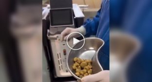 Doctors removed dozens of stones from the bladder of a soda lover