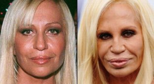 Stars before and after plastic surgery (21 photos)