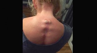 Женщина, страдающая сколиозом, демонстрирует мучения, причиняемые болезнью (4 фото)