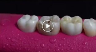 Как лечат зуб от кариеса с удалением нерва