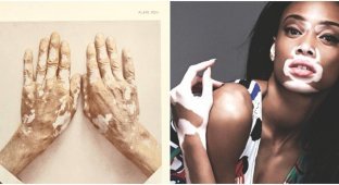 Белое пятно в медицине: история витилиго (8 фото)