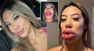The girl decided to make lips for the action and ended up in the hospital (5 photos)