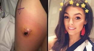 Страх потерять ногу после укуса паука заставил 19-летнюю девушку обратиться к врачам (6 фото)