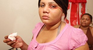Девушка из-за редкого заболевания, плачет кровавыми слезами и потеет кровью (5 фото)