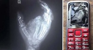 12-летний мальчик остался без пальца и ослеп на один глаз после того, как его телефон взорвался во время зарядки (6 фото + 1 видео)