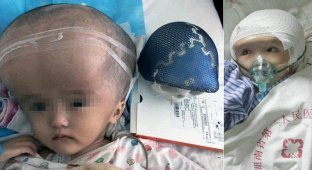 3-летней девочке в Китае пересадили череп, напечатанный на 3D-принтере (8 фото)
