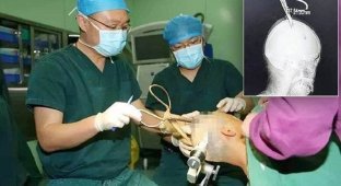Китайские врачи извлекли из головы женщины гигантские ножницы (6 фото + 1 видео)