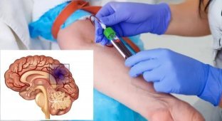 Влияние группы крови на риск раннего инсульта (3 фото)