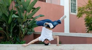 A breakdancer who constantly spun on his head earned himself a bald spot and a growth on his skull (2 photos)