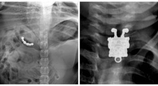 У них це було в тілі: 17 дивовижних рентгенівських знімків (18 фото)