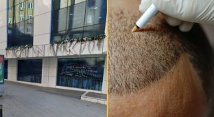 A Briton Dies During a Hair Transplant in Turkey (3 photos)