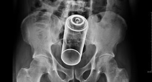 Что вытаскивали медики из американцев в 2017 году (11 фото)