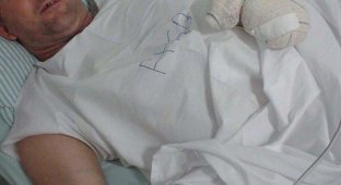 Хирурги вытащили из живота мужика новую руку (17 фото)