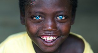 Невероятно красивые глаза африканского мальчика, подаренные ему болезнью (9 фото)
